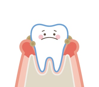 初期歯周病の歯と歯ぐき