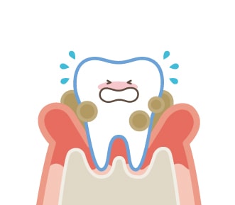 中期歯周病の歯と歯ぐき