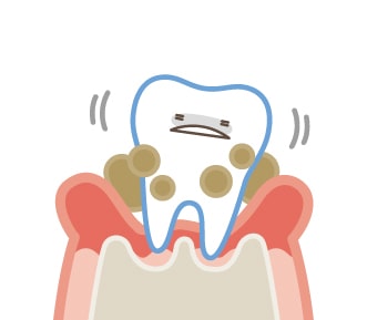重度歯周病の歯と歯ぐき