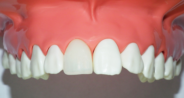 前歯の被せ物（クラウン）CAD/CAM
